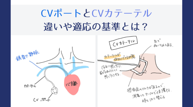 CVポートとCVカテーテルの違い、適応の基準って何？｜視点Nからお送りします